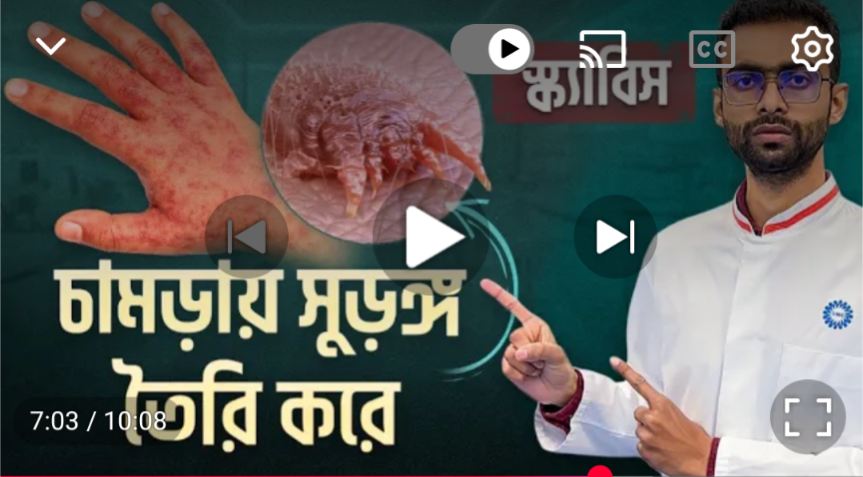 স্কাইবিশ হলে আমরা কি কি ভুল করি